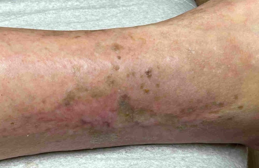 chronic wound care covered by Medicare Part B