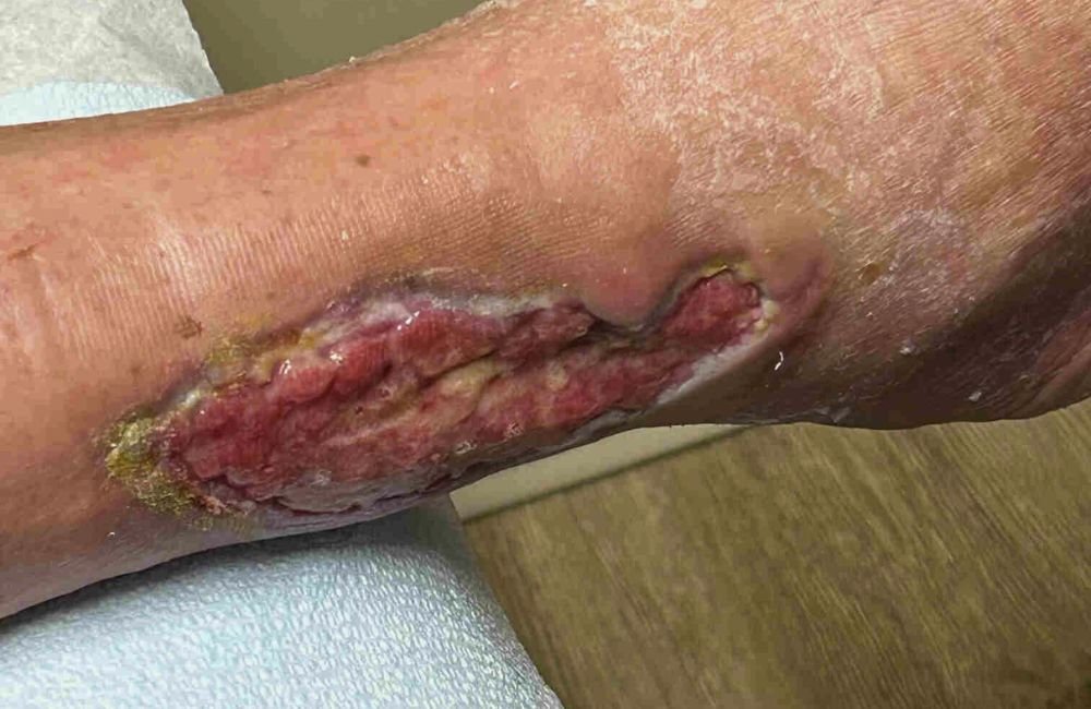 chronic wound care covered by Medicare Part B